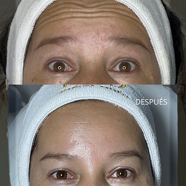 Antes-y-después-toxina