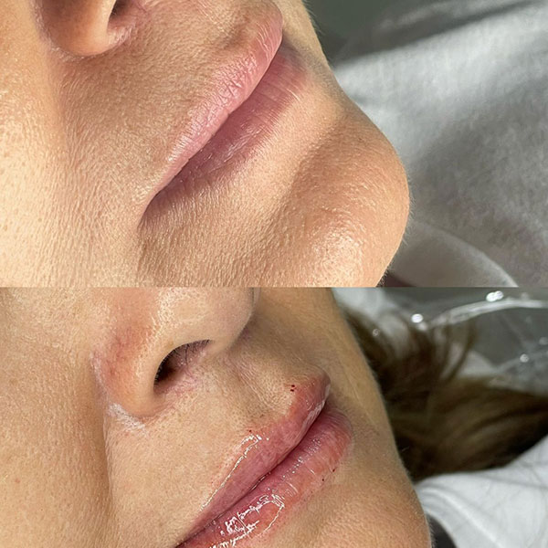 Labios-Acido-hialuronico-2