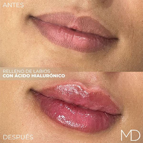 Labios-Acido-hialuronico