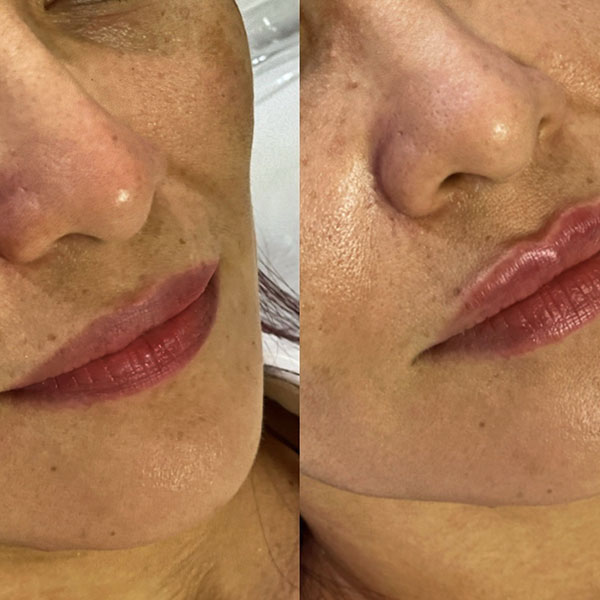 Labios-Acido-hialuronico2