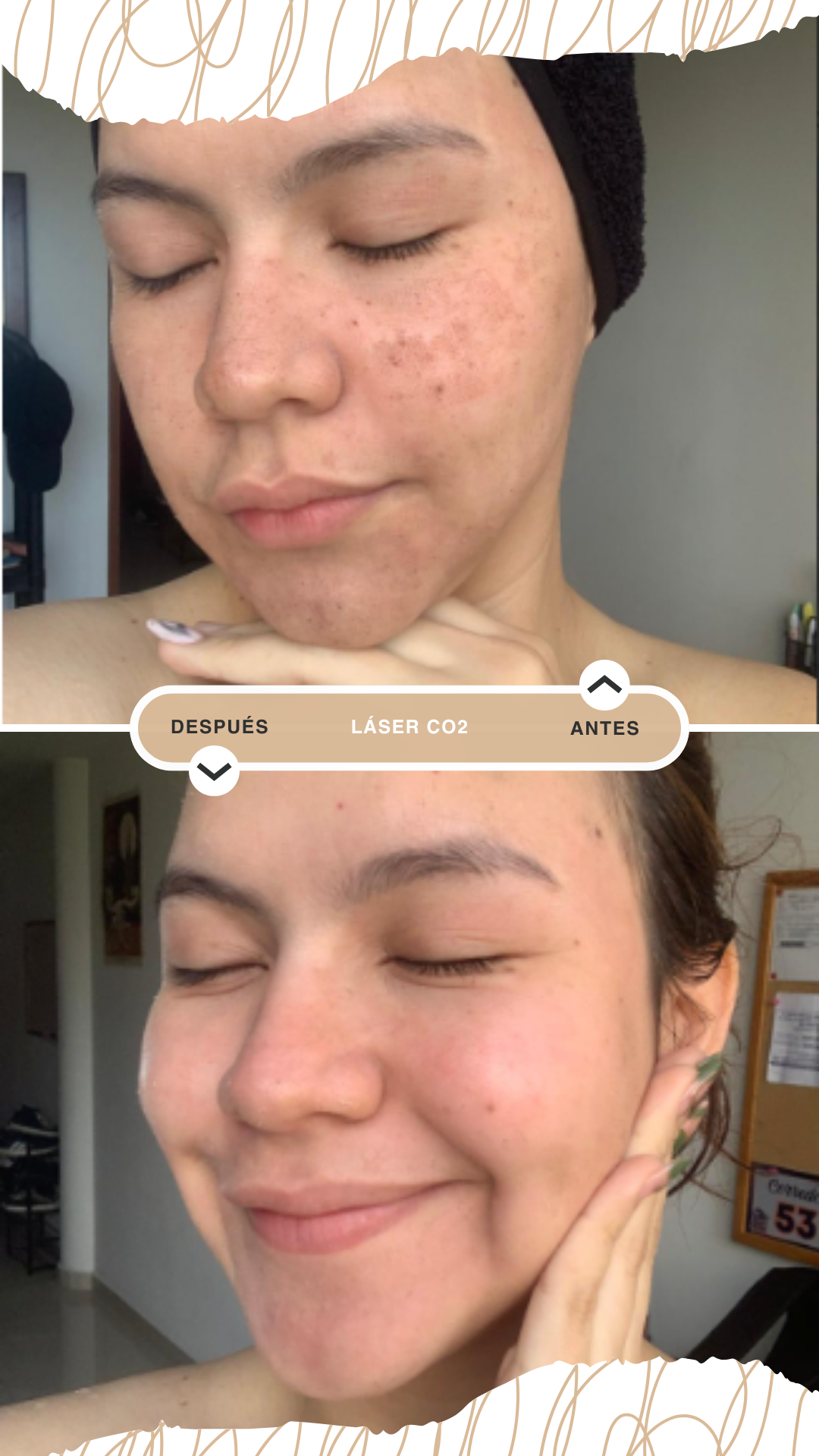 laser CO2 (Antes Despues)